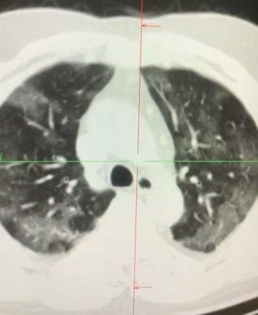 Koronavirus 50 yaşlı azərbaycanlı qadının ağciyərlərini bu hala saldı - 