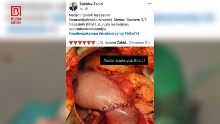 Cərrah Zahid Zahidovun əməliyyat görüntülərini paylaşması ilə bağlı  