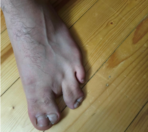 Ayağında 3 barmağı olsa da, hərbi xidmətə göndərildi - 